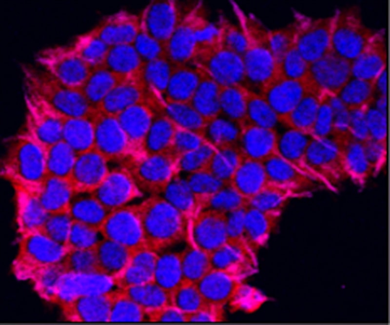 Confocal microscopy showing enhanced vimentin expression in cancer cells